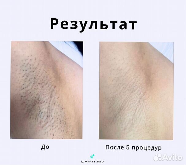 Диодный лазер Лю’минес максван 1200в