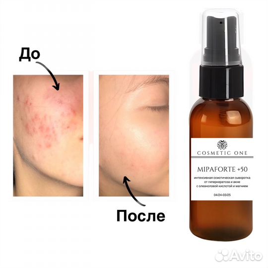 Сыворотка от гиперкератоза и акне