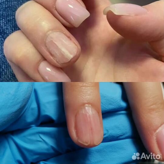 Подолог, вросший ноготь, грибок, зачистка