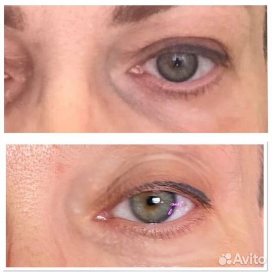 Безоперационная Блефаропластика