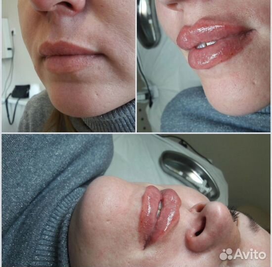 Увеличение губ,Ботокс,Липолитик,Биоревитализация