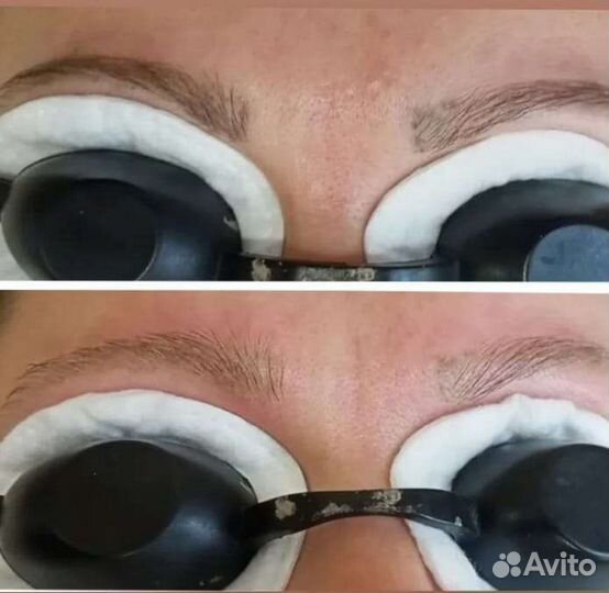 Удаление тату/ажа лазером