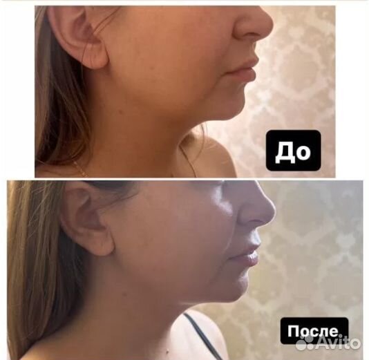 Безоперационная липосакция