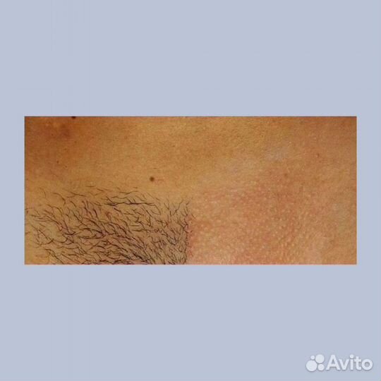 Шугаринг, воск, депиляция