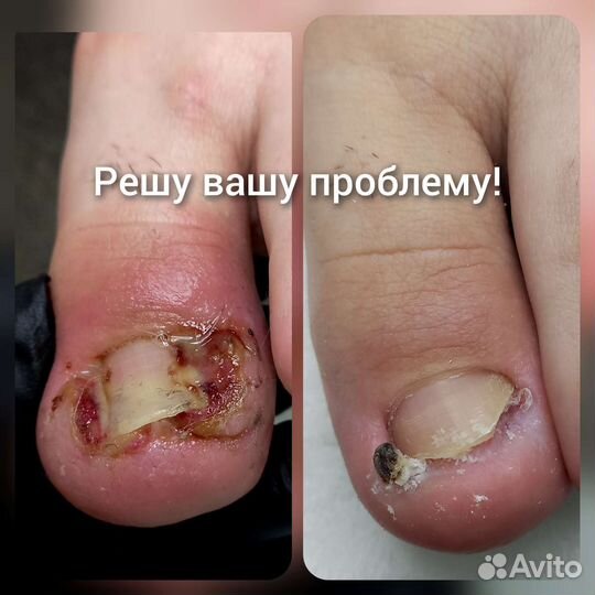 Педикюр подолог