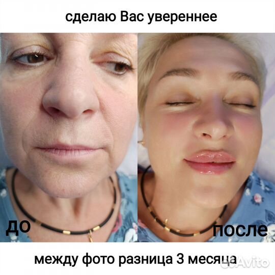 Косметолог/чистка лица/увеличение губ/ботокс/нити