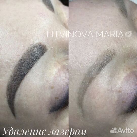 Удаление татуажа