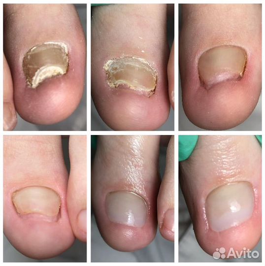 Подолог. Медицинский педикюр. Титановая нить