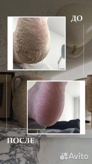 Аппаратный педикюр