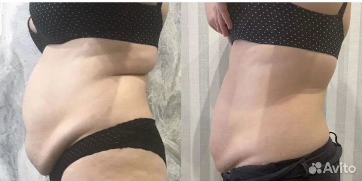 Массаж липолазер удаление жира в Перми