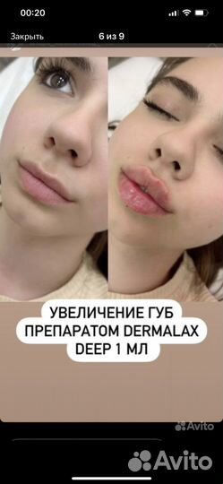 Увеличение Губы.Ботокс.Чистка лица