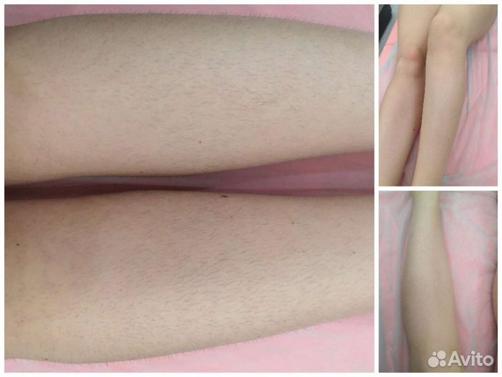 Шугаринг: подмышки