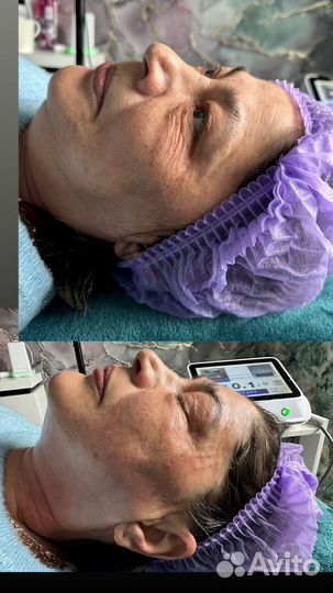 SMAS лифтинг подольск