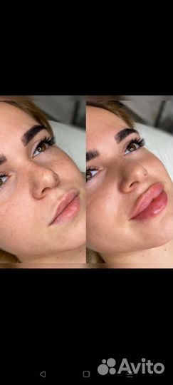 Услуги косметолога контурная пластика