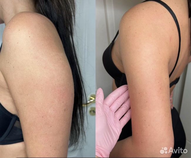 Курс Топ 10 процедур стройности «Турбо Slim»