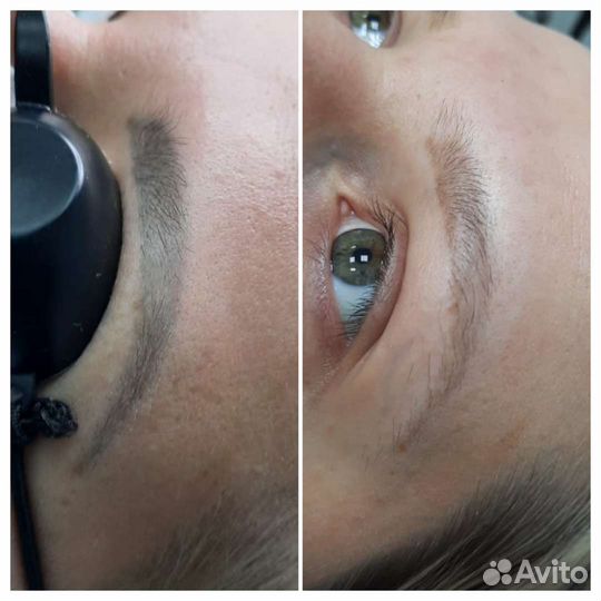 Удаление тату и татуажа