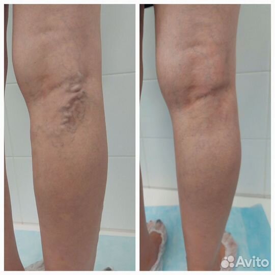 Аппаратный массаж против варикоза