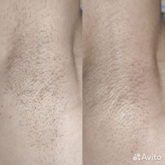 Депиляция воском и шугаринг