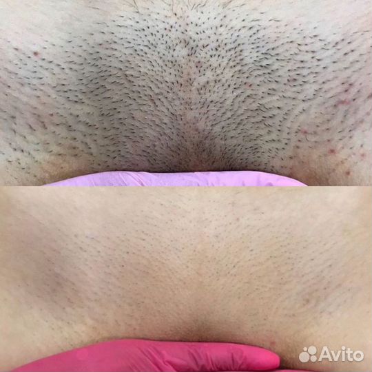 Лазерная эпиляция: глубокое бикини