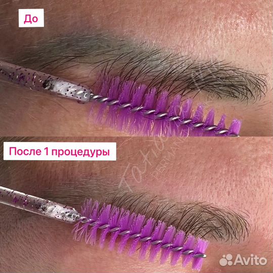 Удаление ремувером татуажа