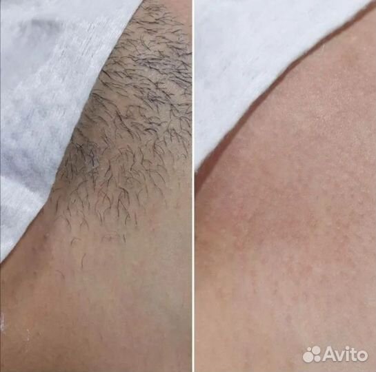 Депиляция Шугаринг Интимное омоложение Адлер