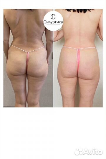 Антицеллюлитный аппаратный массаж