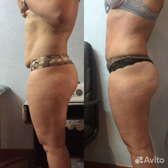 Аппаратный массаж / Вакуумный массаж / Кавитация