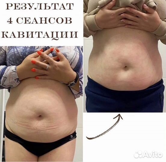 Ультразвуковая кавитация