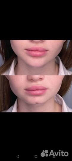 Услуги косметолога контурная пластика