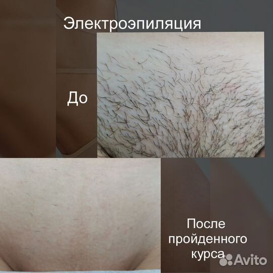Электроэпиляция