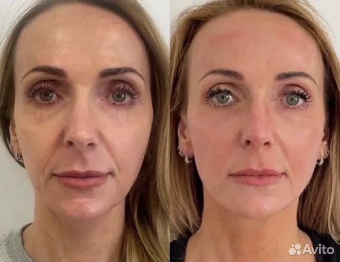 Смас лифтинг процедура Москва