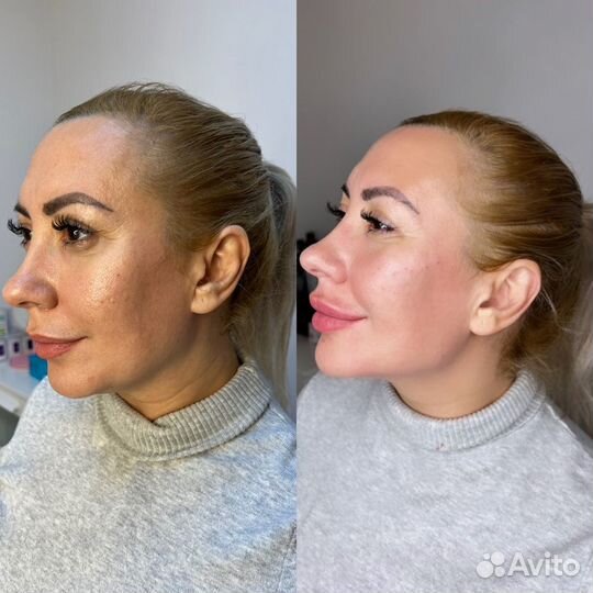 Контурная пластика губ, Эпиляция. Косметолог