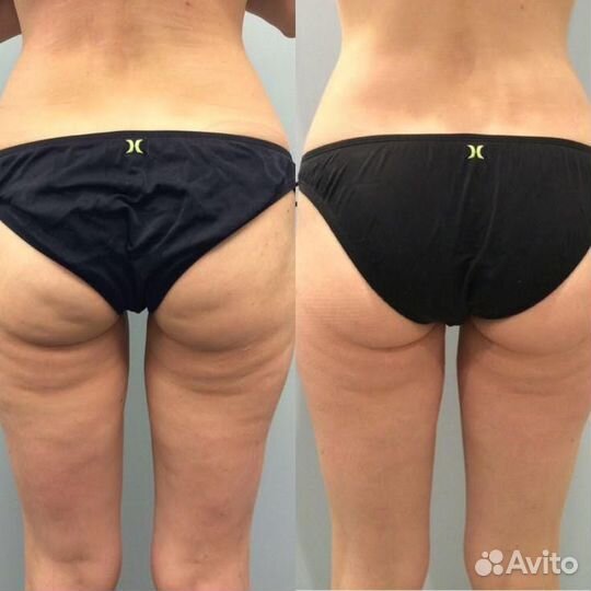 Аппаратный антицеллюлитный массаж