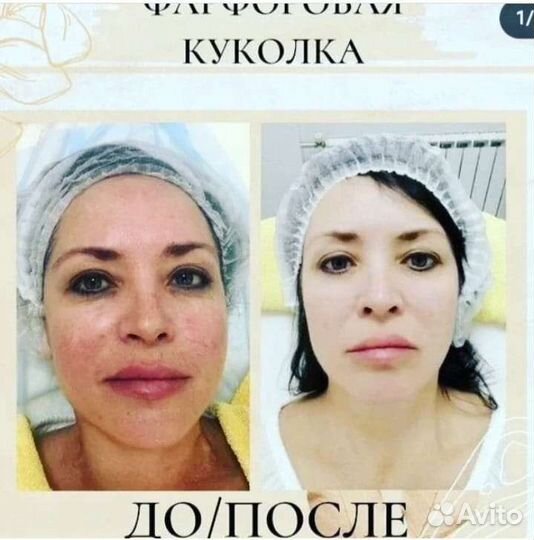 Процедура Фарфоровая куколка