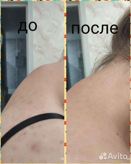 Костоправ/Правка Атланта