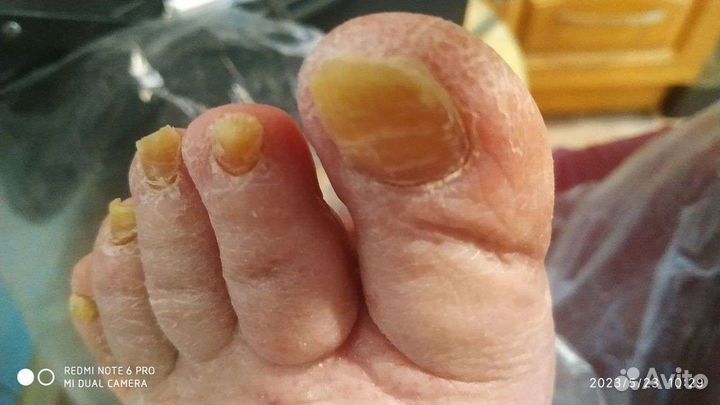 Лечебный педикюр