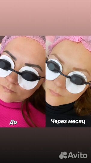 Лазерное удаление тату