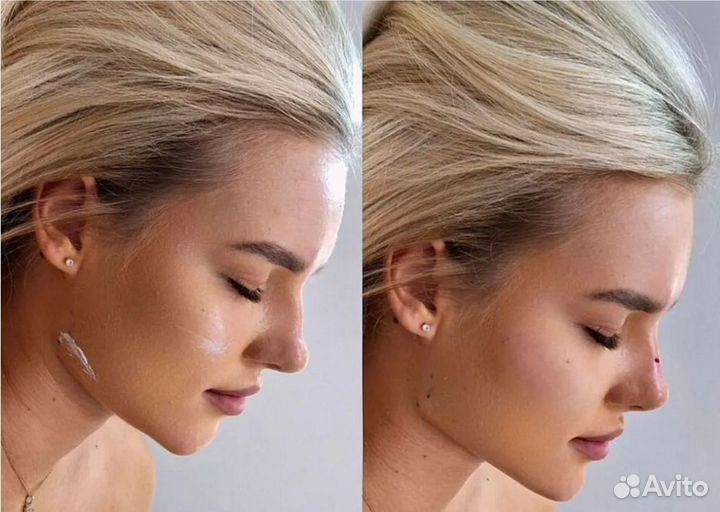 Подтяжка лица за 1 процедуру. СМАС лифтинг