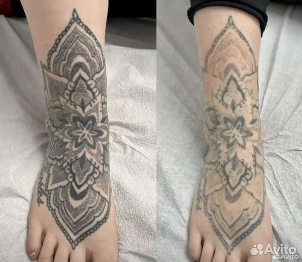 Лазерное удаление татуажа и тату в Москве