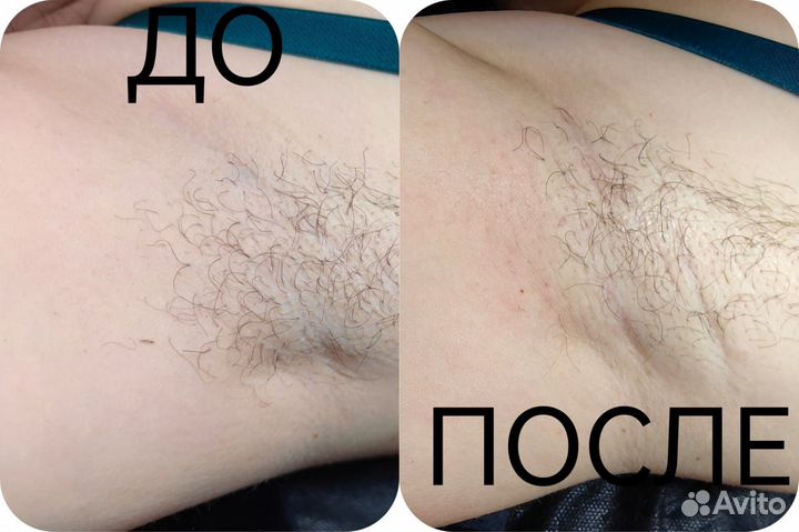 Электроэпиляция