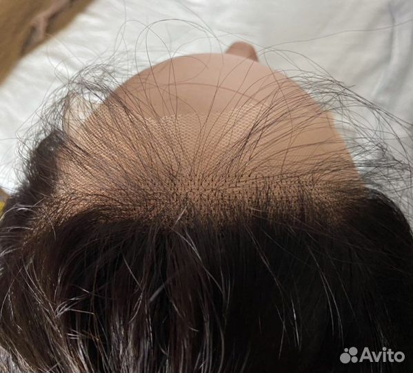 Система замещения волос