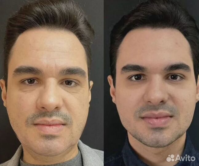 Супер омоложение и подтяжка лица без уколов