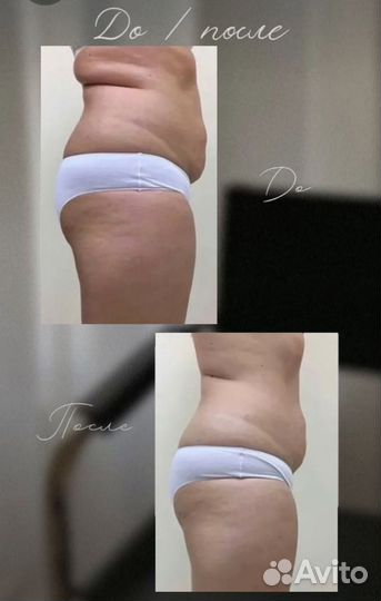 Аппаратный вакуумный массаж вибро баночный массаж