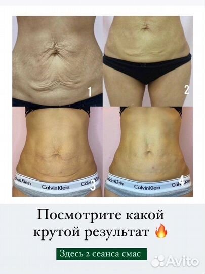 Подтяжка животика, смас лифтинг