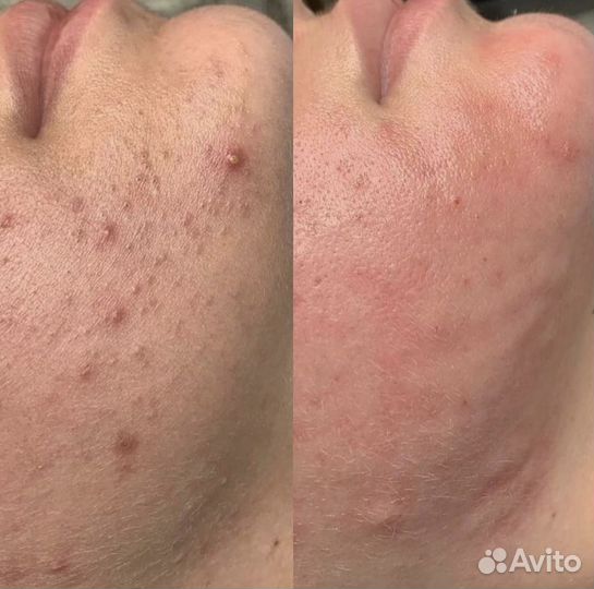 Косметолог Пилинг лица