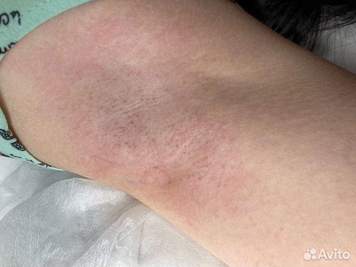 Электроэпиляция