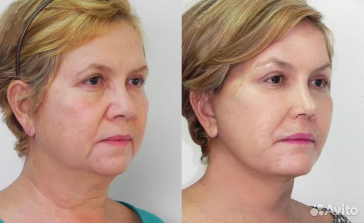 Smas лифтинг Альтера - подтяжка лица