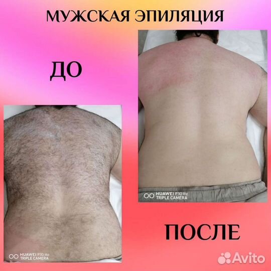 Шугаринг