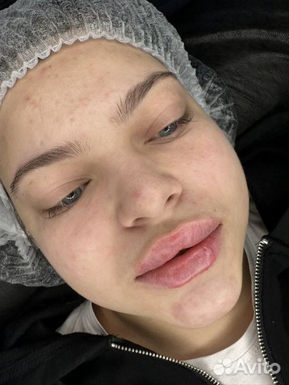 Увеличение губ