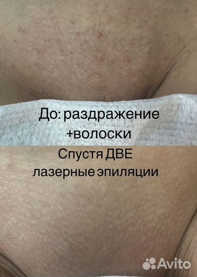 Лазерная эпиляция: бакенбарды